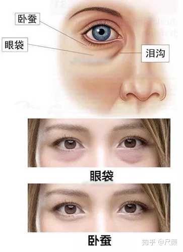 什么是 卧蚕 它跟眼袋有什么区别 知乎 什么是 卧蚕 它跟眼袋有什么区别 知乎