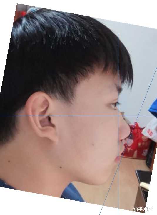 苹果肌突出鼻翼过宽的侧颜怎么拯救?