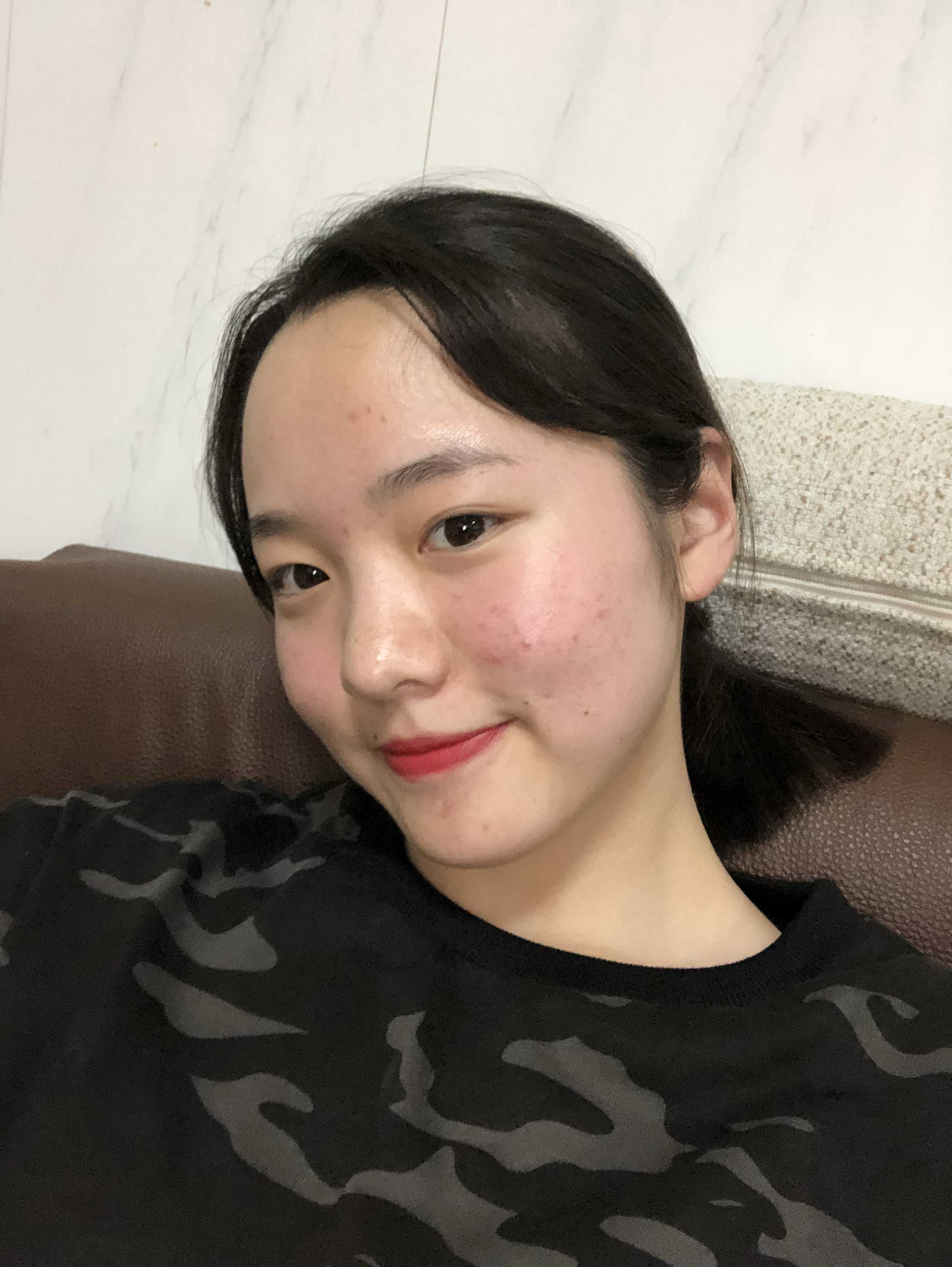 小眼睛 满脸痘 大脸 塌鼻子 厚嘴唇 皮肤差 这是今年六月份 痘痘好多