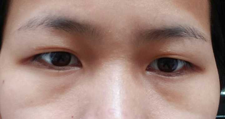 鸡皮肤色素黑眼圈去除医美(皮肤不好黑眼圈 查激素六项)