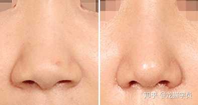缩鼻头是不存在的吗,听说切除的最终还是会长起来?