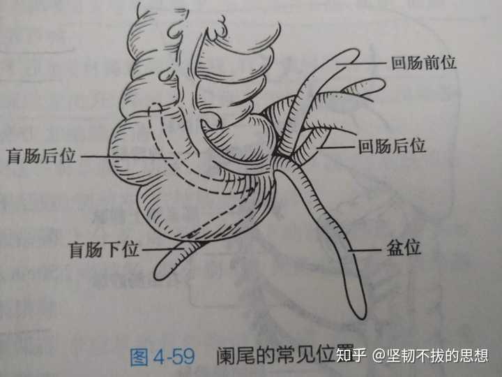 由于盲肠末端游离,而阑尾属于腹膜内器官,因此阑尾位置变化较大