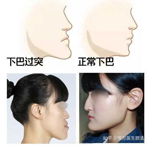 有人嫌下巴短,有人又嫌下巴长,引起下巴… - 知乎