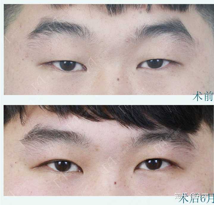 我这样的属于眼肌无力吗,该怎么缓解?