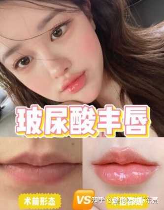 【玻尿酸丰唇你不知道的事!】 1,玻尿酸丰唇效果自然.
