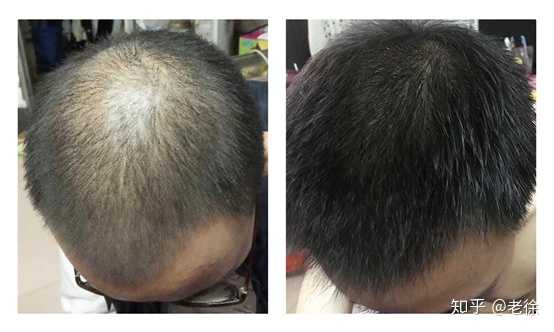 脱发到什么程度才适合植发?