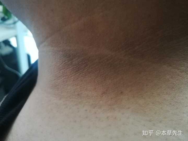 脖子后面黑黑的 看起来很脏 怎么解决?