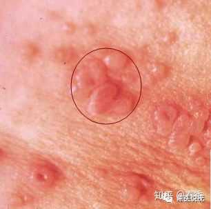 这种情况可能是被误诊的尖锐湿疣吗?