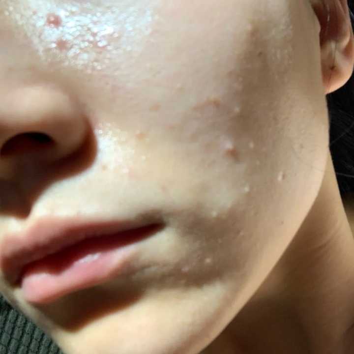 闭口怎么形成的 怎么去 知乎