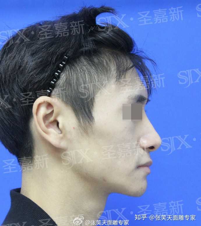 我一个男生想去削骨,可以吗?