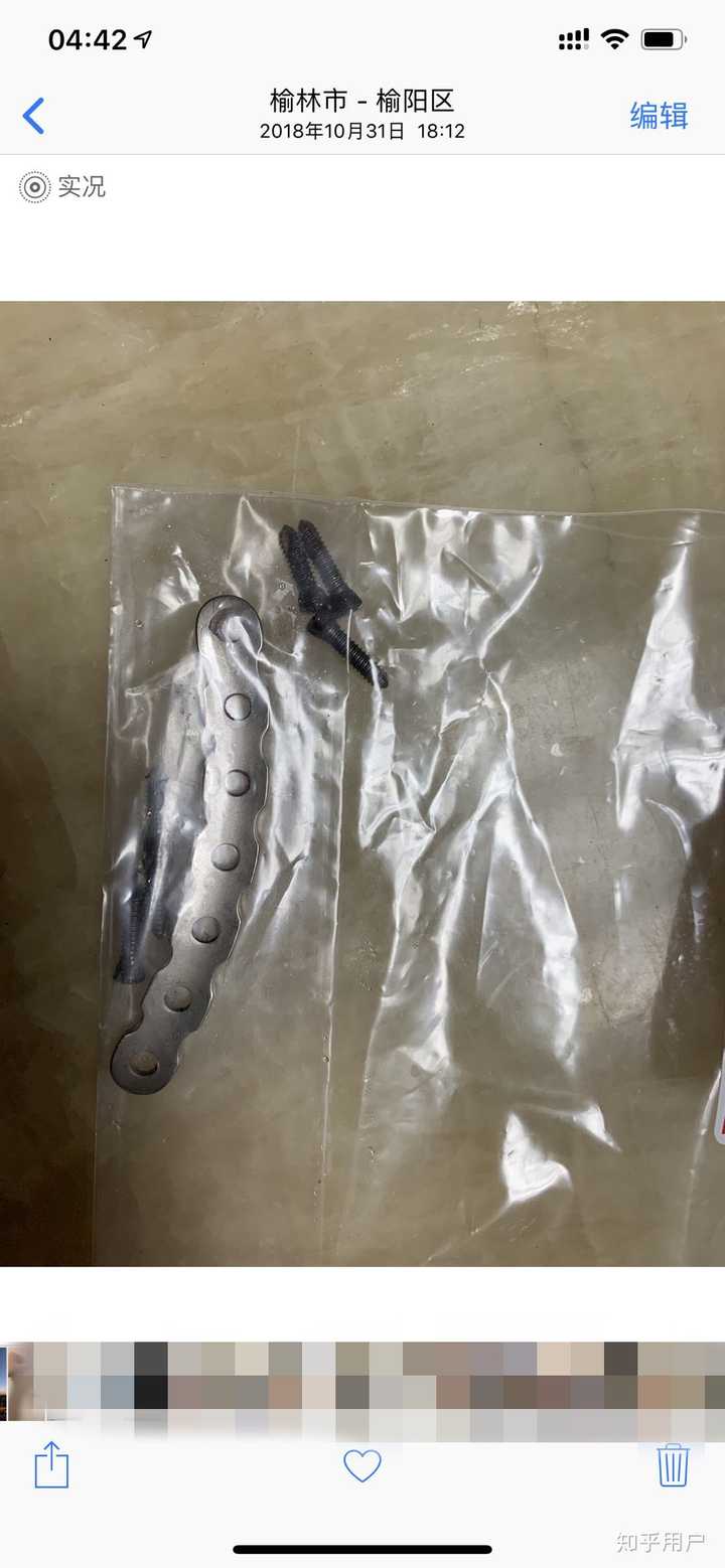 锁骨骨折是一种什么样的体验 知乎 锁骨骨折是一种什么样的体验 知乎