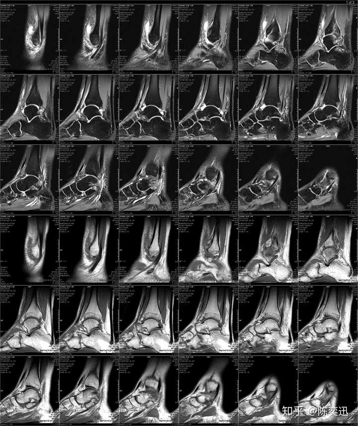 关注问题 67写回答运动损伤韧带拉伤韧带韧带损伤有多严重?