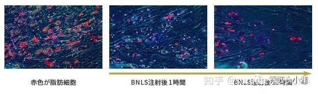 可以请学医或者医美的人谈谈溶脂针的效果或危害吗 打过的人献身说法最好了 知乎