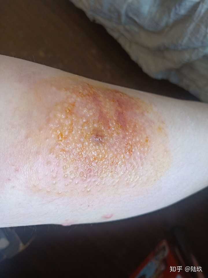 你见过得最奇葩的过敏体质是对什么过敏?有什么过敏症状?