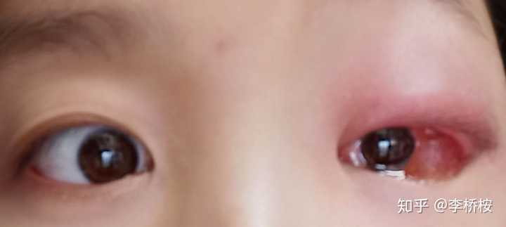 一只眼睛上眼皮和眼角突然肿了这是为什么 李桥桉的回答 知乎 一只眼睛上眼皮和眼角突然肿了这是为什么 李桥桉的回答 知乎
