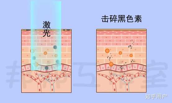 痘痘消退后留下的黑色素沉淀怎么快速消退？ 知乎