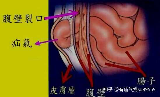 疝修补术:通过将缺损周围组织缝合修补疝环口