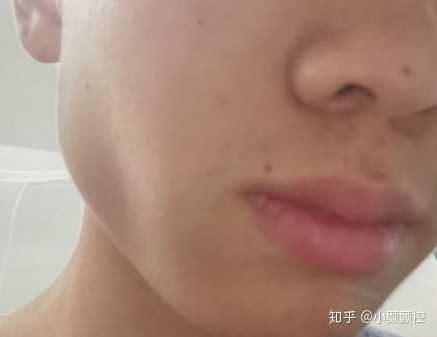 像我这种是咬肌大吗