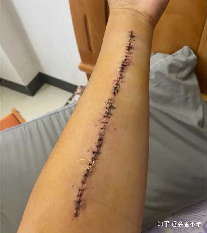 大臂内侧有纹身植皮去除后可以通过警察录用体检么