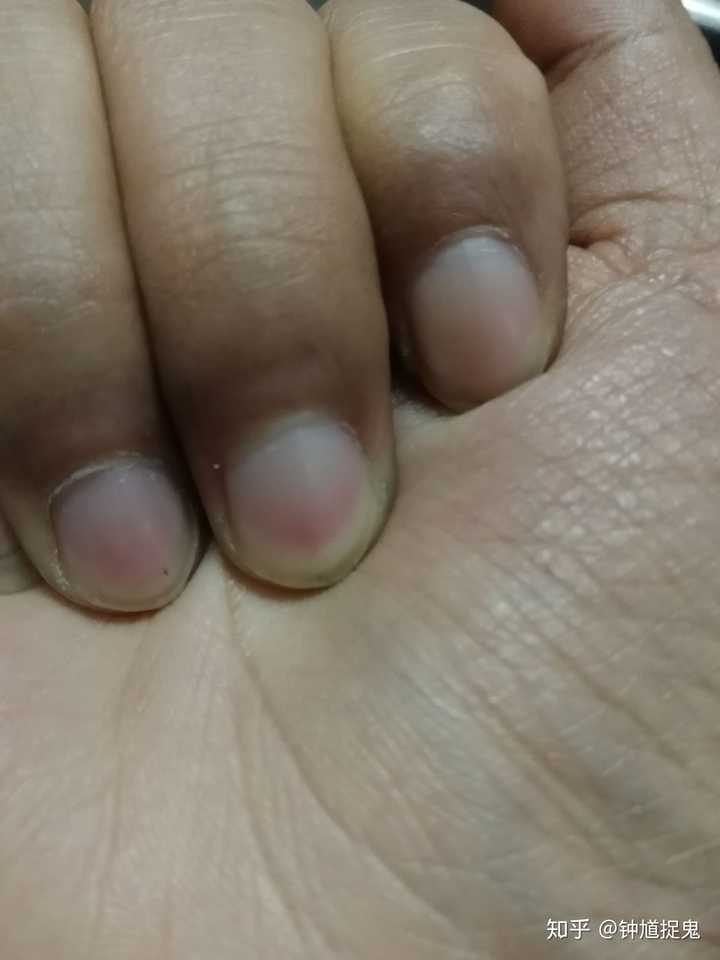 指甲下面的黑点?