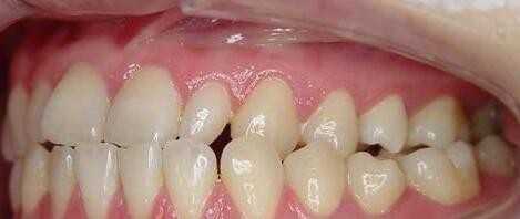 上排牙齿整体向左偏,而且越往右边走越向下斜?