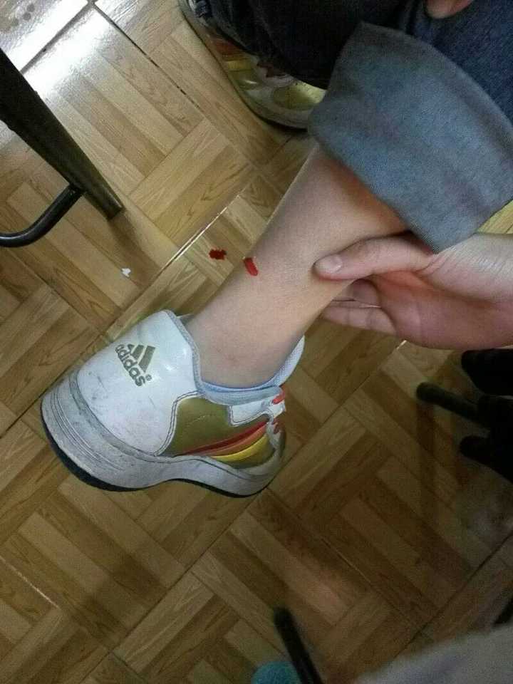 有次脚割破了,自己还没注意,室友倒是心疼得不行,各种准备邦迪啊红