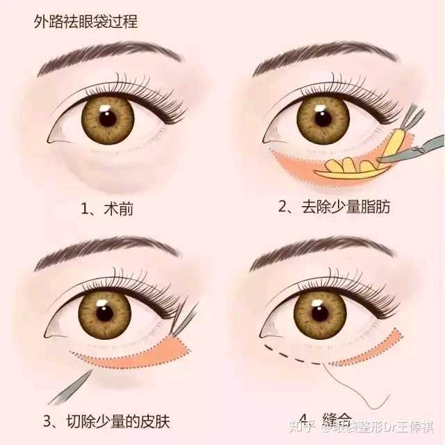 为什么会有眼袋 知乎 为什么会有眼袋 知乎