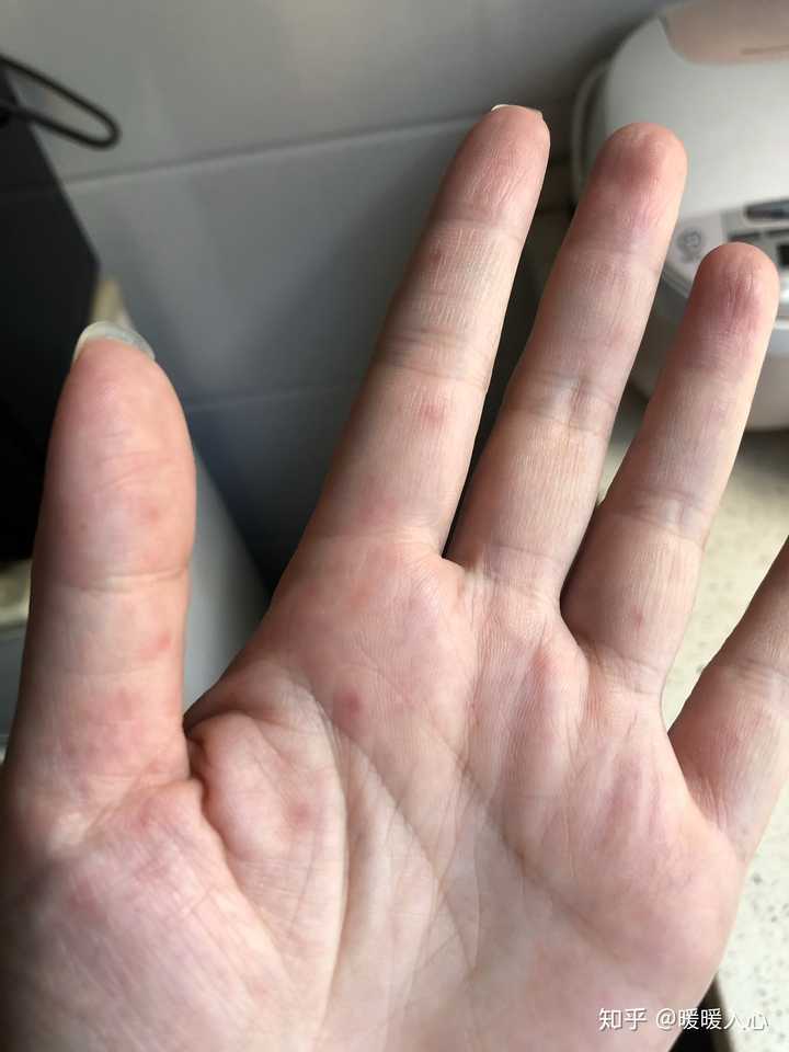 成年人得手足口病什么感觉?