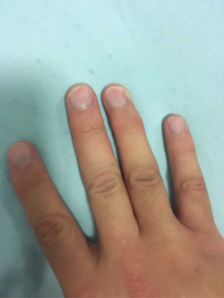 大家的拳茧都啥样了想见见