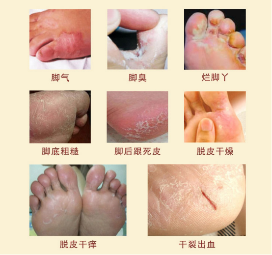 如何根治脚气,烂脚丫?