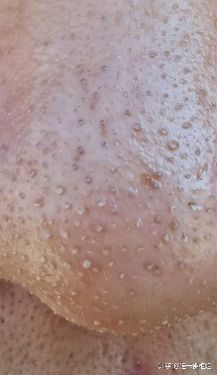 怎么去除鼻子的大黑头