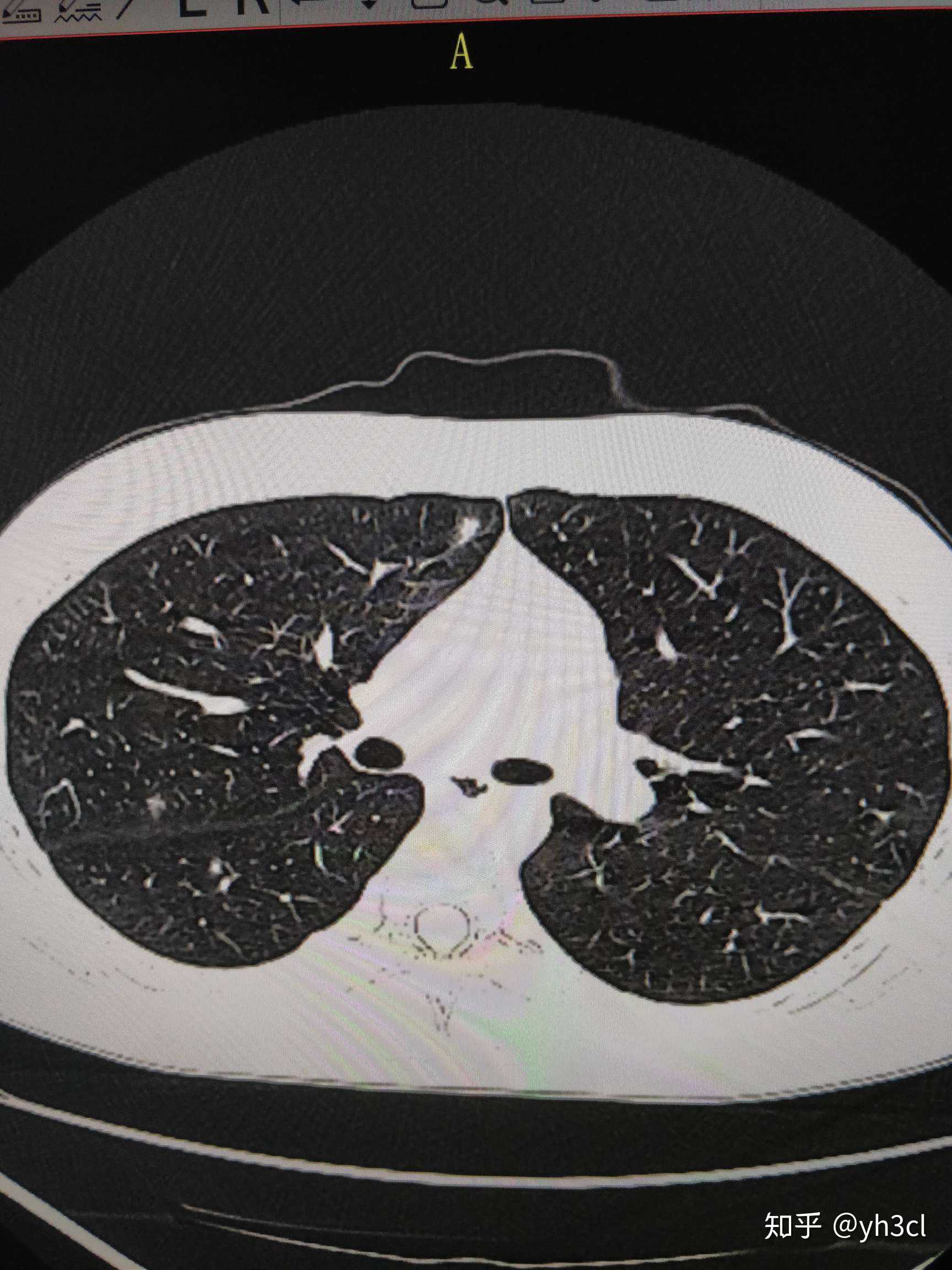 肺部结节图片查看图片