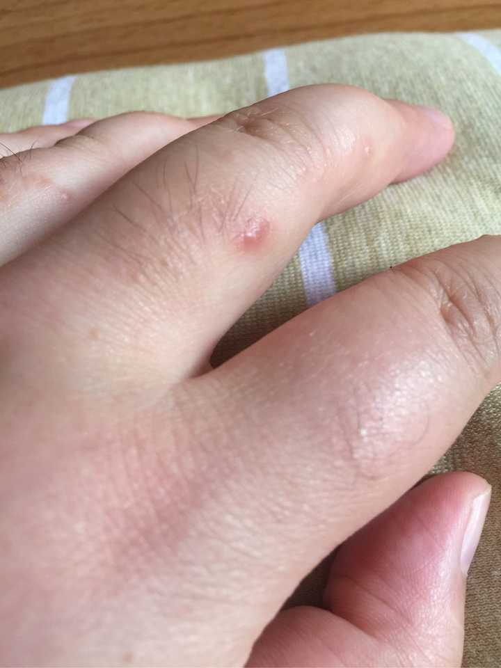 天气热手脚长小水泡,天气凉了自动就好了,湿疹or汗疱疹?