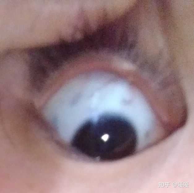 为什么眼白中有些黑色斑块 知乎 为什么眼白中有些黑色斑块 知乎