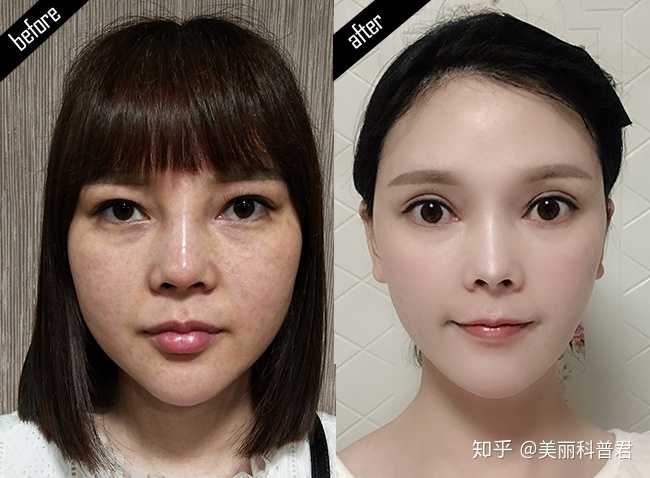 如果并不是脂肪多,而是骨头宽大外突,那只有做颧骨手术.
