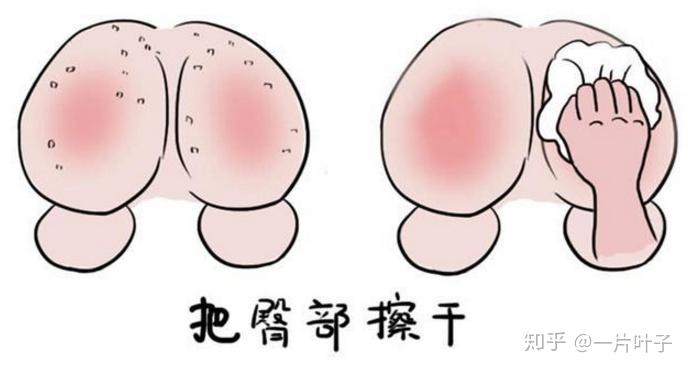 女婴尿道两边红感染图片