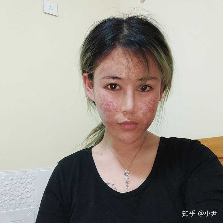 不是,我那个啥,我只是痘痘靠科技治好了我痘印痘坑都有啊,问我痘印