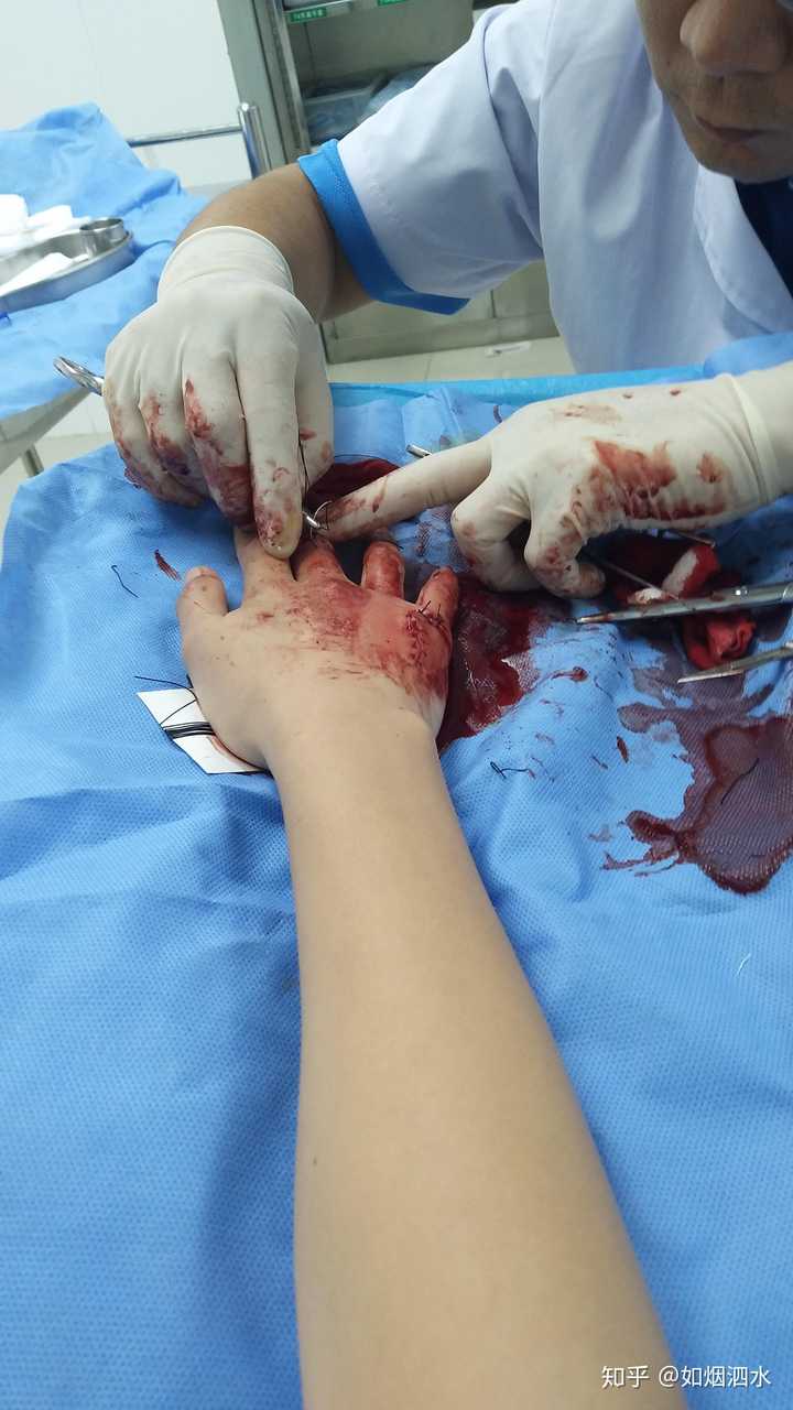 去年夏天由于作死右手受伤了,因为刮台风的原因自己先处理了一下伤口