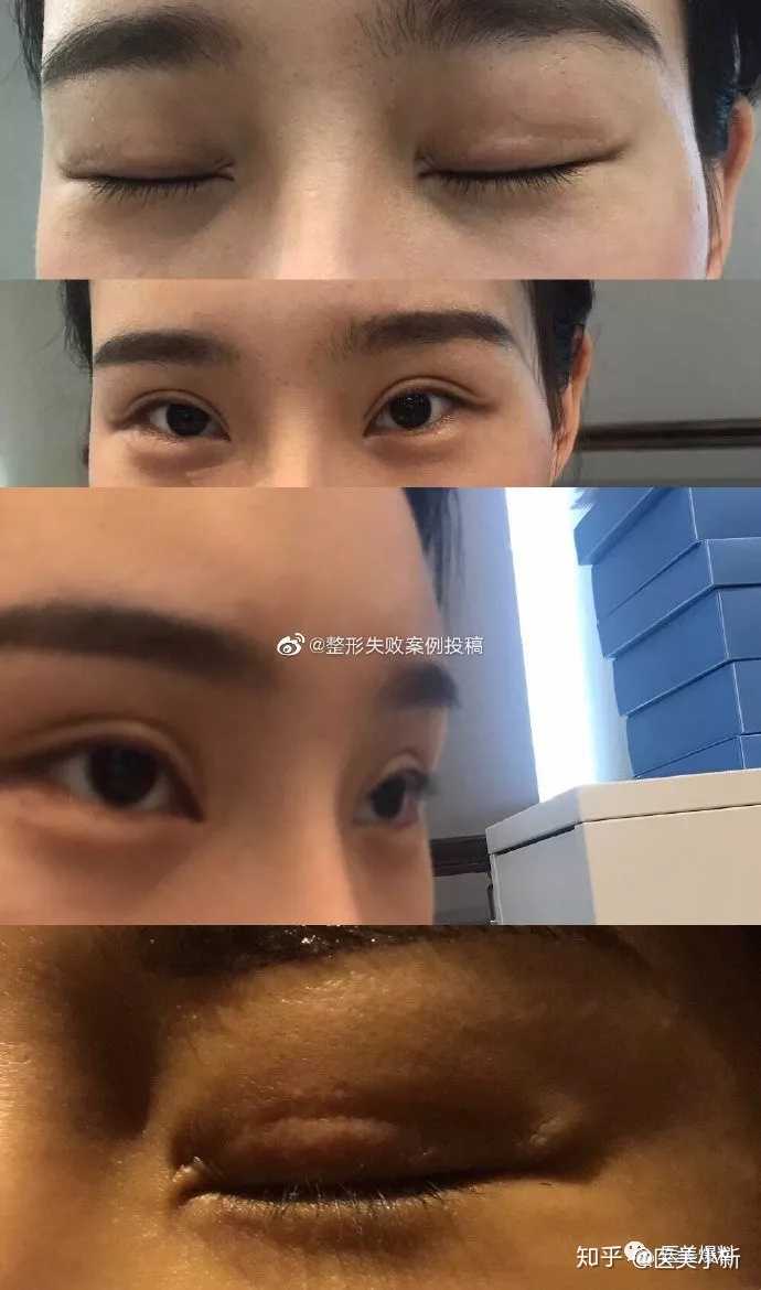 整形失败 有点活不下去了怎么办 知乎 整形失败 有点活不下去了怎么办 知乎