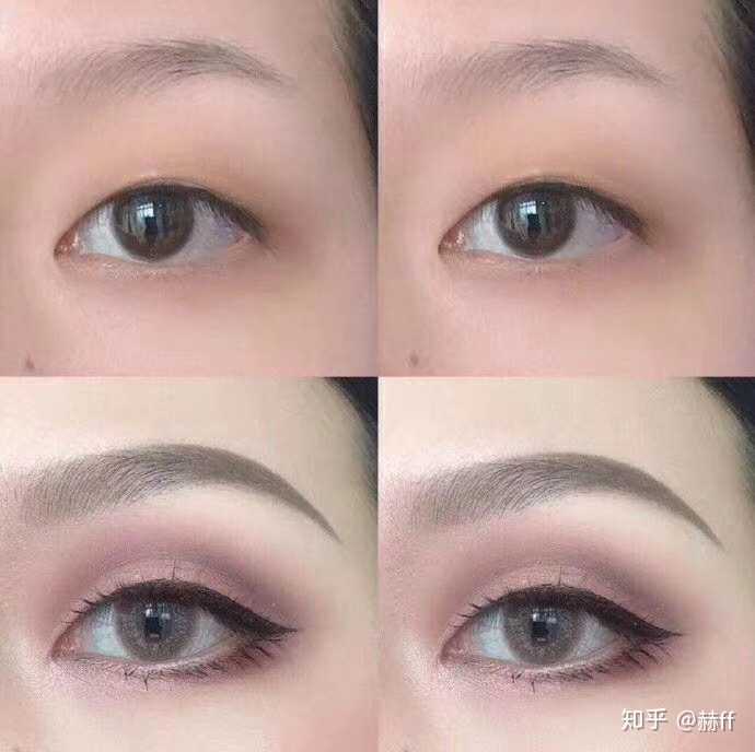 我的单眼皮上有一条线,长大后会变双吗?