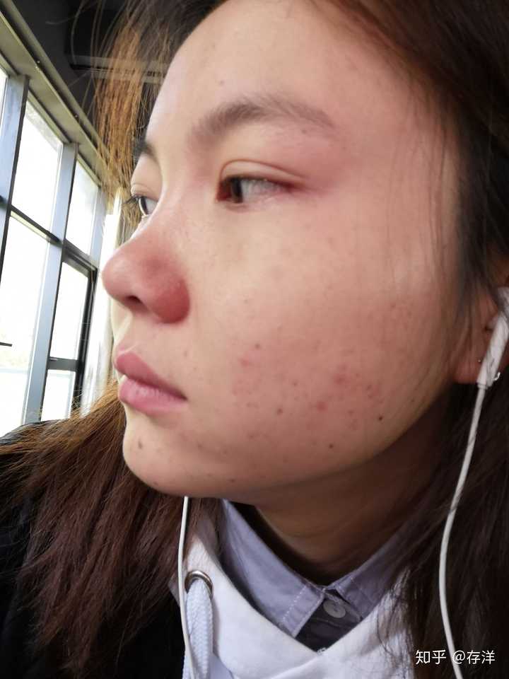 怎么看待五官漂亮但是皮肤差的女性?