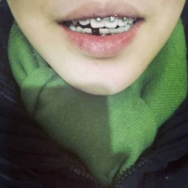 戴牙套是一种怎样的体验?