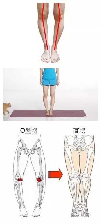 O型腿如何矫正? - 知乎