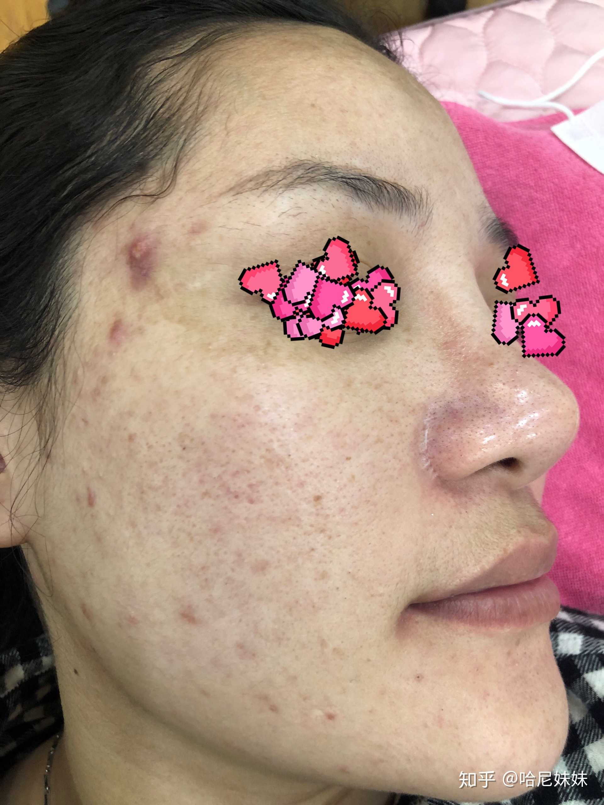 所以大家看到我的照片都是痘印黄褐斑还有含铅汞斑和后面没处理好的两