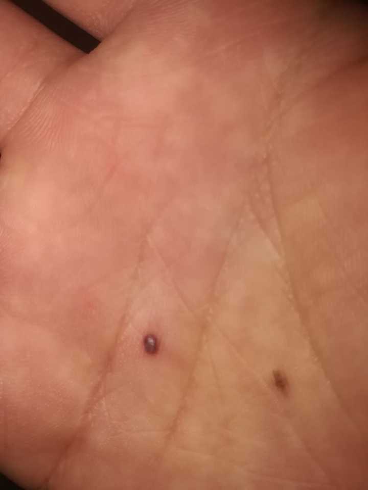 手上的黑痣突然变大不痛不痒?