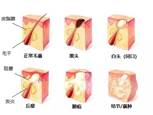 脸上的痘痘能挤吗 知乎