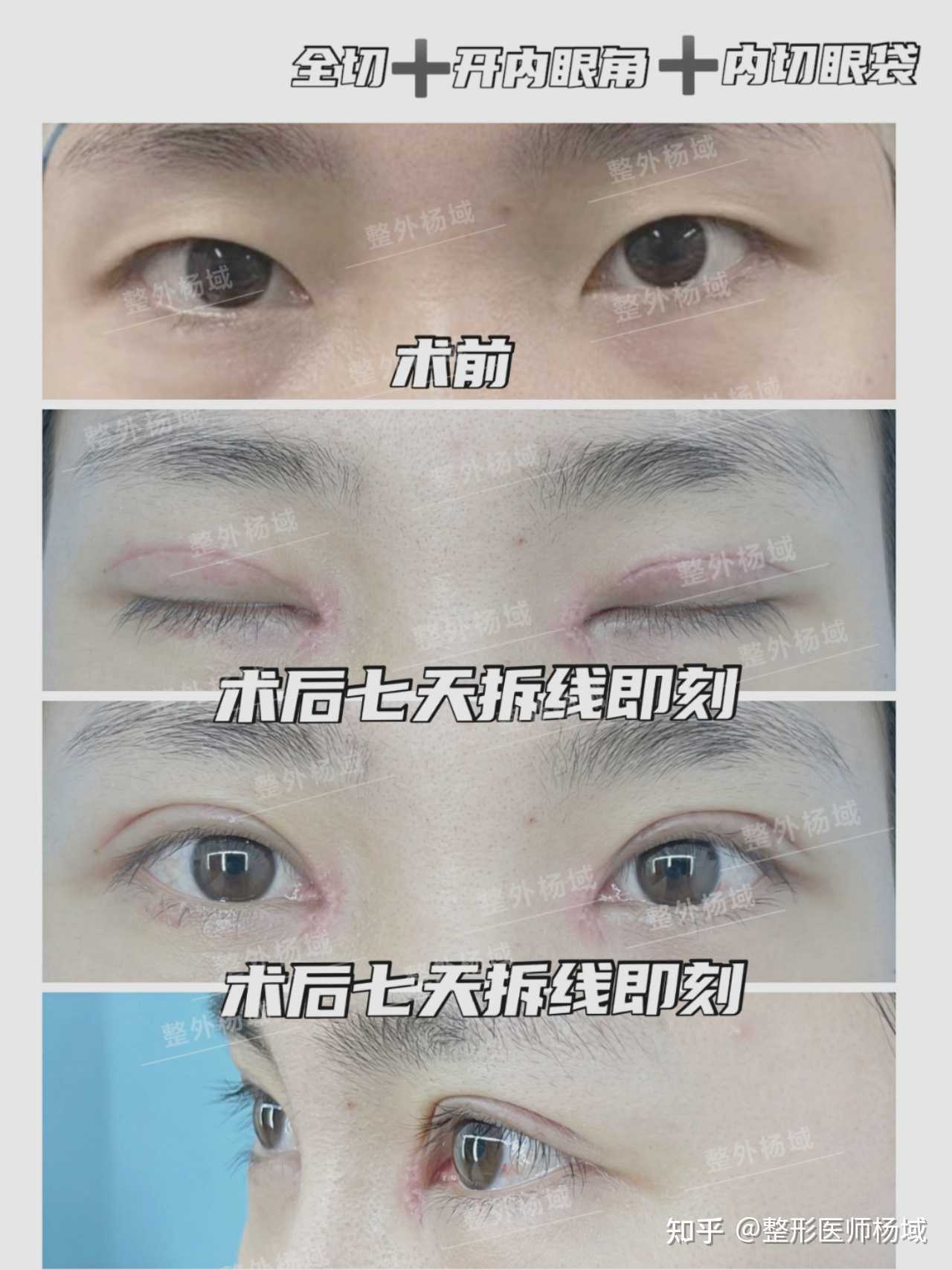 做双眼皮要不要开眼角