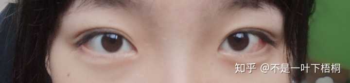 斜视的人是怎么正常与人交往 有什么样感受 知乎