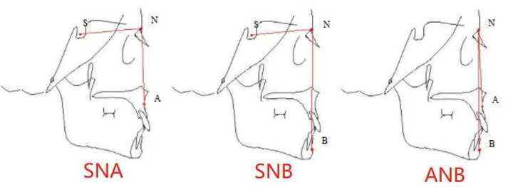 然后会测量你的这三个数据snb,sna,anb角 别急,其实牙友们只要知道