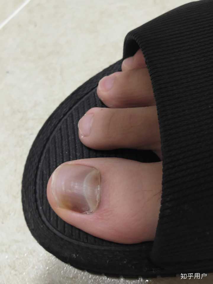 大脚趾指甲盖下有黑点图片